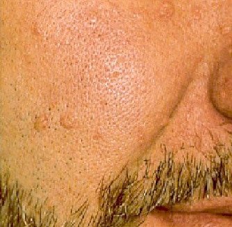 Dermatosen auf der Wange